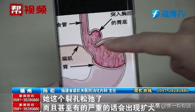 女子長期惡心、反酸，竟因胃跑入胸腔？醫(yī)生：這個(gè)作息習(xí)慣很不好