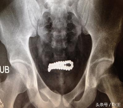 尿道自插導尿管、筆芯、筷子等異物，引發(fā)的治療迷思！
