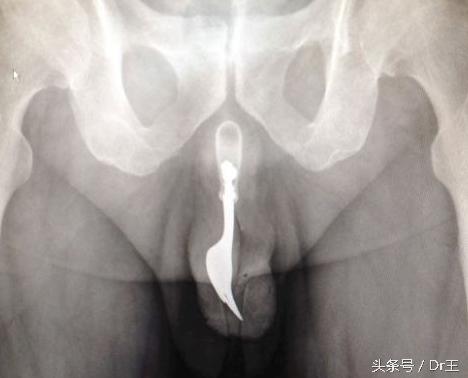 尿道自插導尿管、筆芯、筷子等異物，引發(fā)的治療迷思！