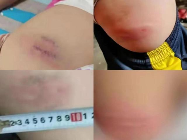 13歲學(xué)生因未完成作業(yè)，屁股被老師打開(kāi)了花！警察：不違法