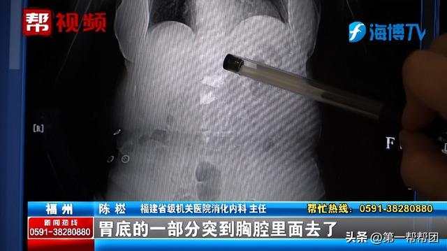 女子長期惡心、反酸，竟因胃跑入胸腔？醫(yī)生：這個(gè)作息習(xí)慣很不好